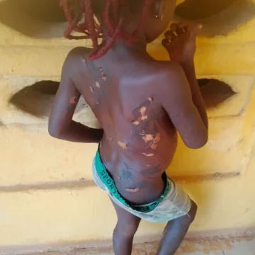 Police arrest mother in Anambra for burning daughter with hot knife